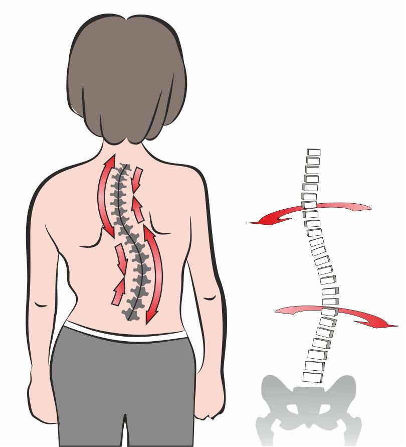 Лечение сколиоза грудного отдела позвоночника