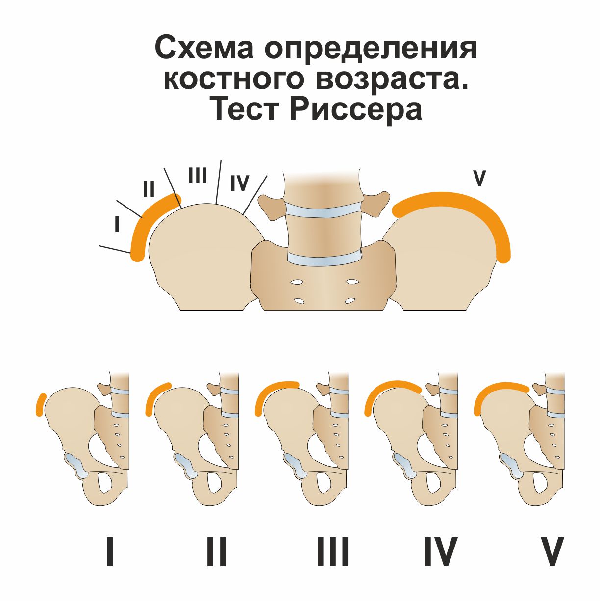 Тест 4 степени. Тест риссера сколиоз. Тест риссера при сколиозе. Признак риссера 4 степени. Признак риссера при сколиозе.