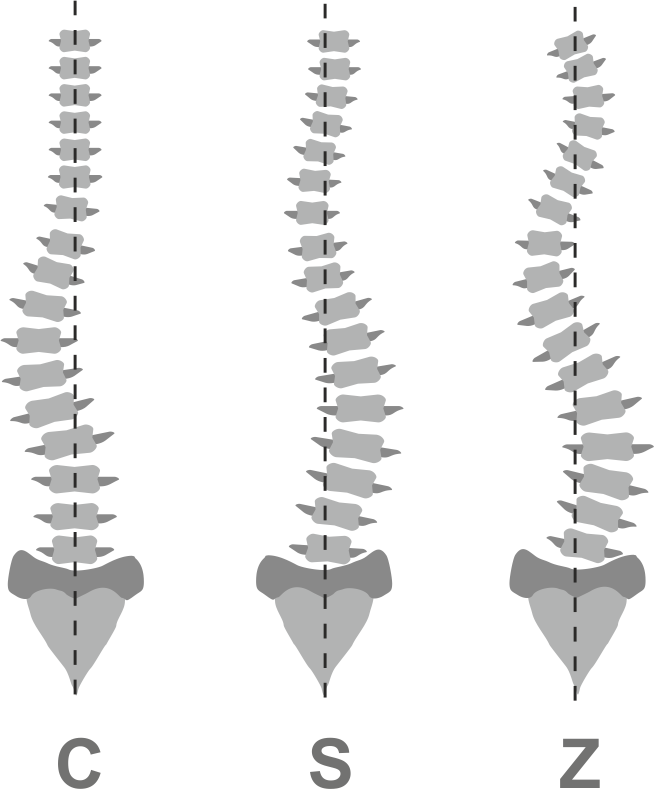 Позвоночник s образной формы у человека. Z образный сколиоз позвоночника. Сколиоз позвоночника с образный сколиоз. Z образный правосторонний сколиоз. Z образный сколиоз 1 степени.