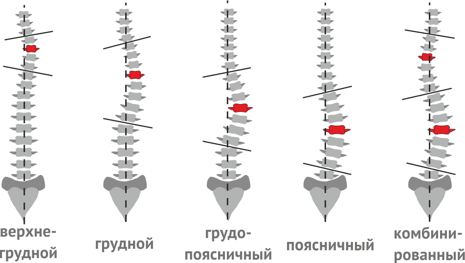 Виды сколиоза