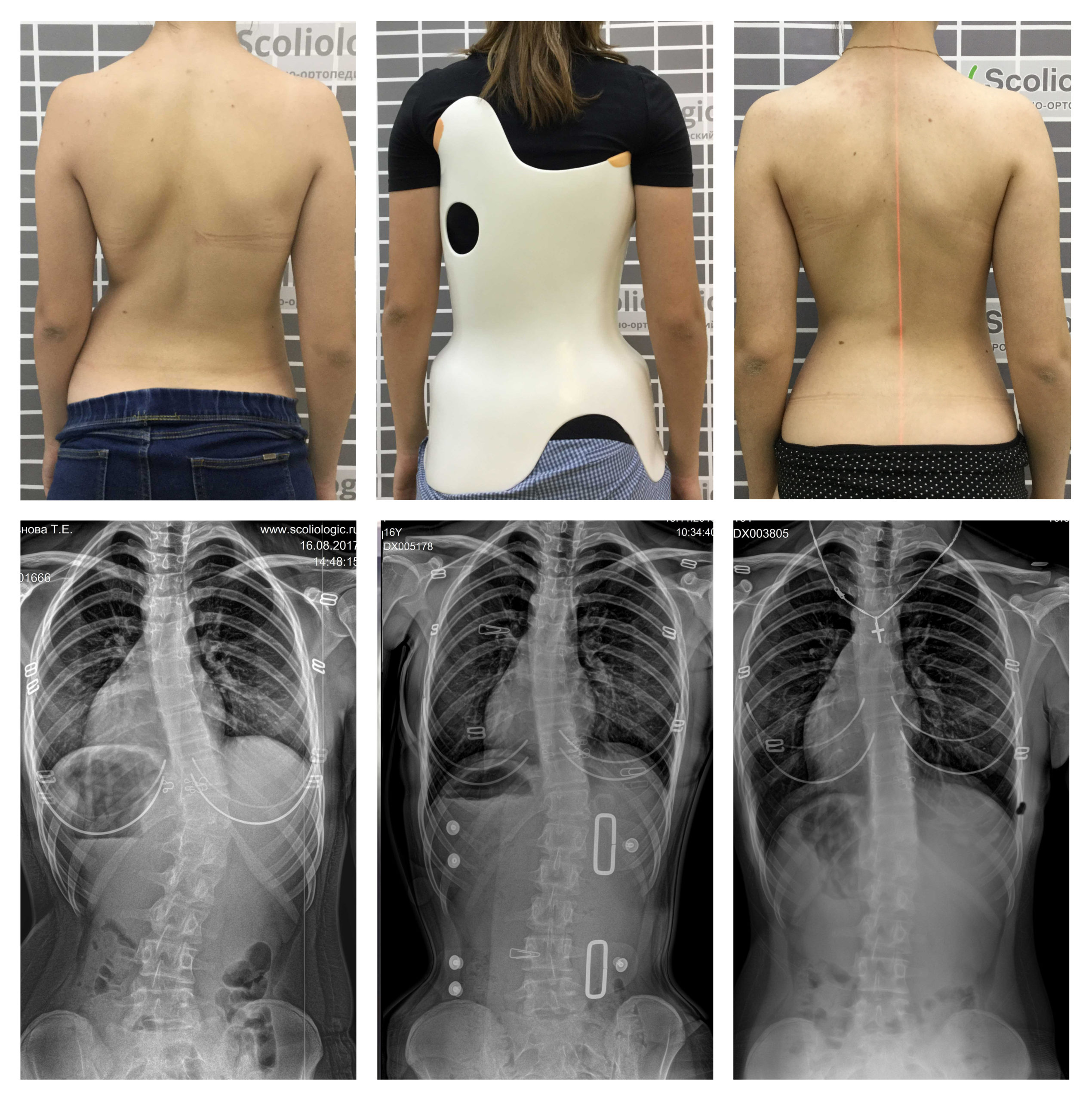 Как выглядит сколиоз 2 степени. Корсет Шено Шейерман Мао. Корсет Шено для Шейермана МАУ. Корсет Шено сколиоз 2 степени. Корсет Шено сколиоз 2-3 степени.
